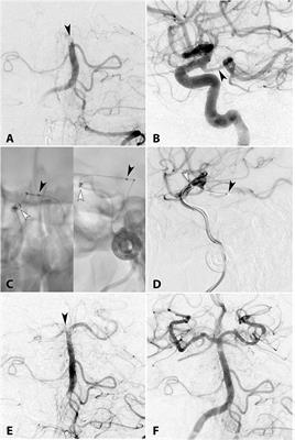 Transcirculation Approach for Mechanical Thrombectomy in Acute Ischemic Stroke: A Multicenter Study and Review of the Literature